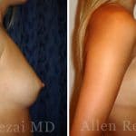 81-side