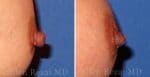 Nipple Surgery in London, Sheffield UK