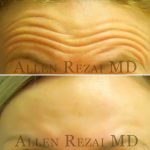 1 - Forehead Lines Treated with Botox