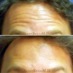 12-Forehead Lines Treated with Botox