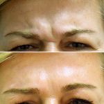 2-Frown (Glabella) Lines Treated with Botox