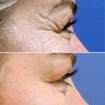3-CrowsFeet Treated with Botox