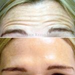 5-Forehead Lines Treated with Botox