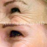6-CrowsFeet Treated with Botox