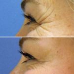 9-CrowsFeet Treated with Botox