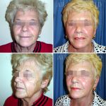 Facelift-necklift10