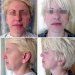 Facelift-necklift11