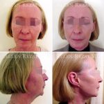Facelift-necklift2