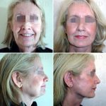 Facelift-necklift3