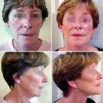 Facelift-necklift5
