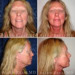 Facelift-necklift6
