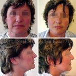 Facelift-necklift7