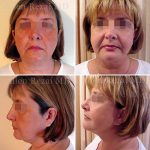 Facelift-necklift8