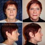 Facelift-necklift9