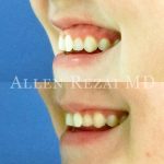Gummy Smile 2