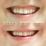 Gummy smile 1