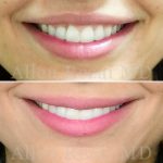 Gummy-smile3