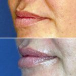 Lips10