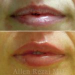 Lips15