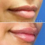 Lips19