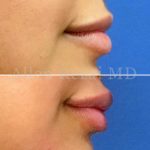 Lips20