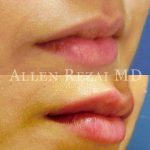 Lips22