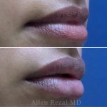 Lips23