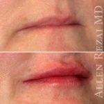 Lips25