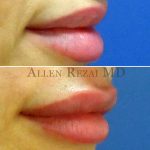 Lips28