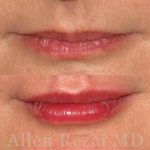 Lips30