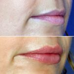 Lips9