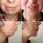 chin-aug2