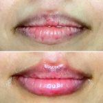 lips1