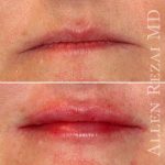 lips7