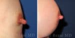 6-nipple-reduction