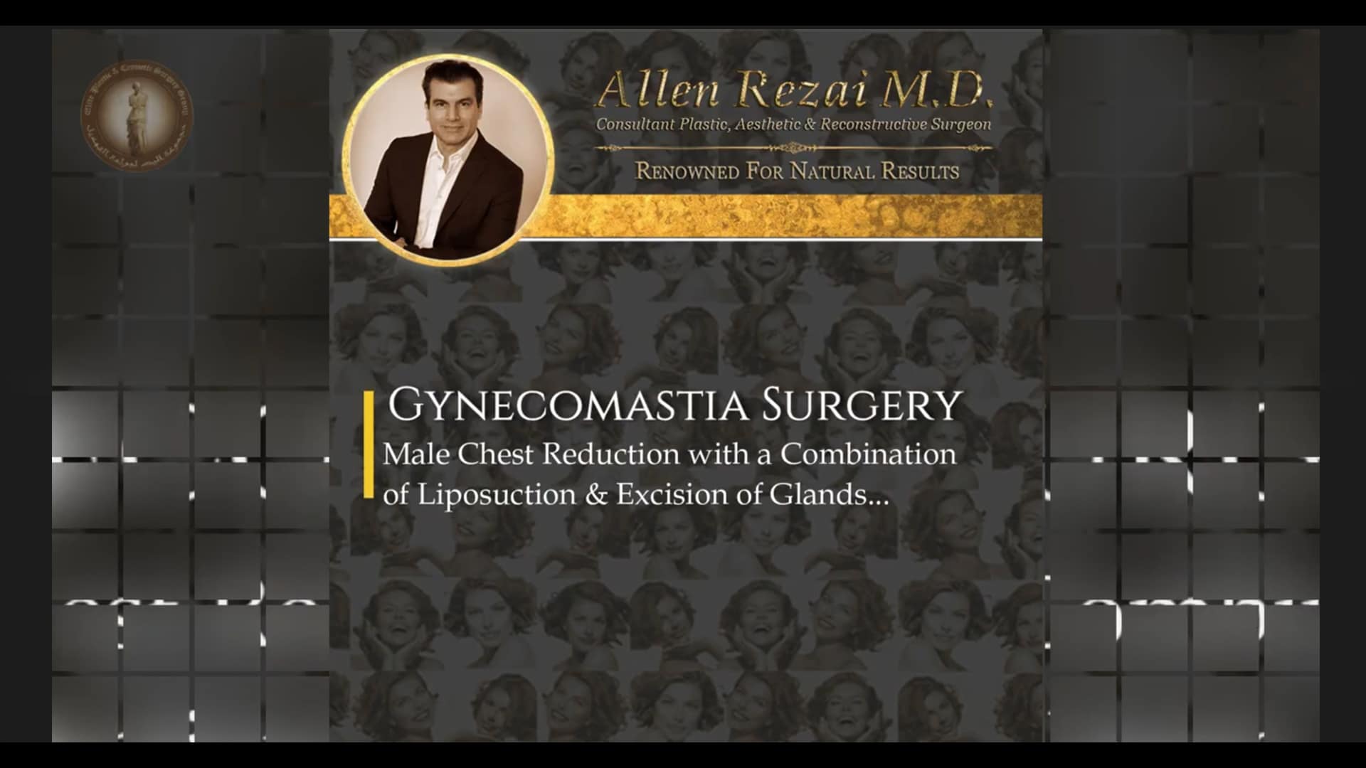 gynecomastia