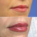 Lips37