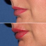 lips35