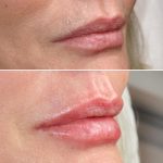 lips36