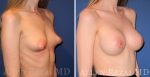 155-oblique