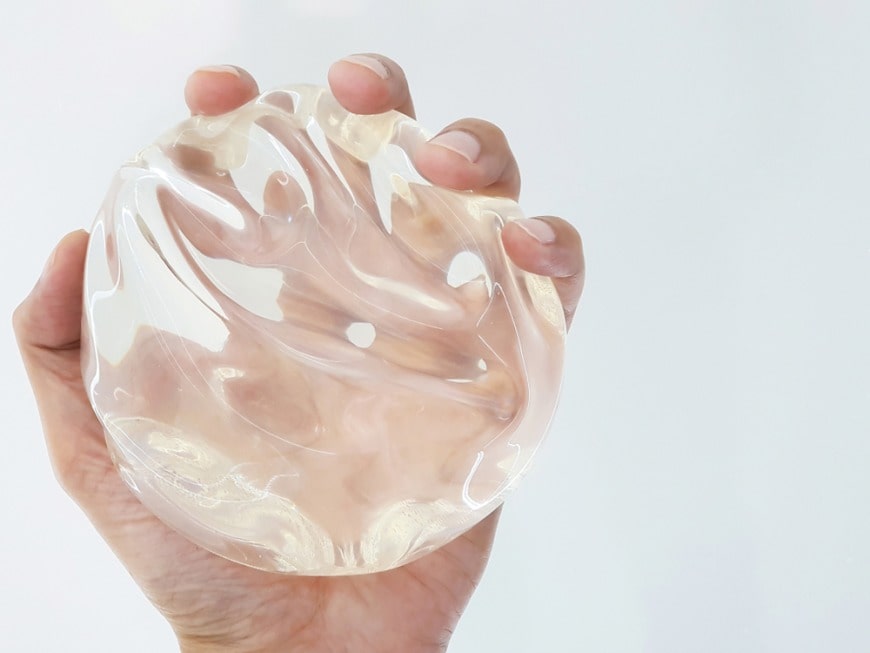 replace implants after 10 years replace implants after 10 years