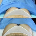 buttocks