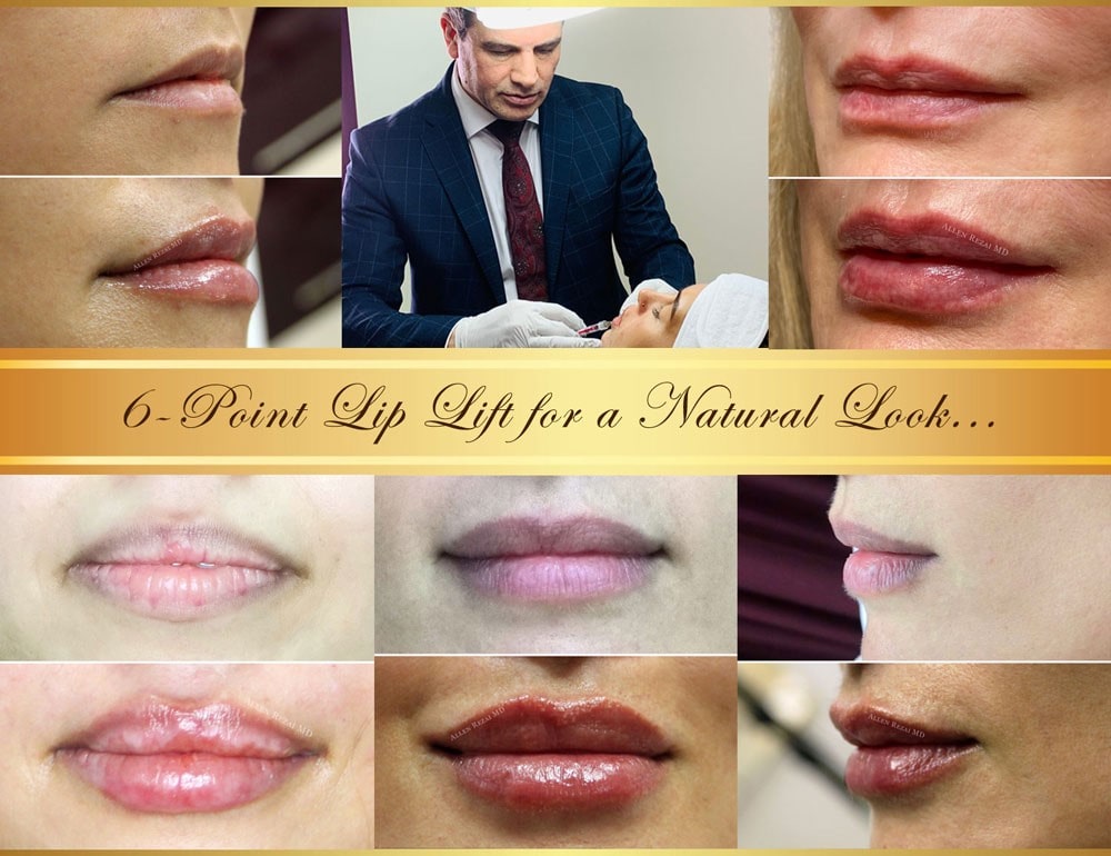 6 point lip lift-min 6-point lip lift