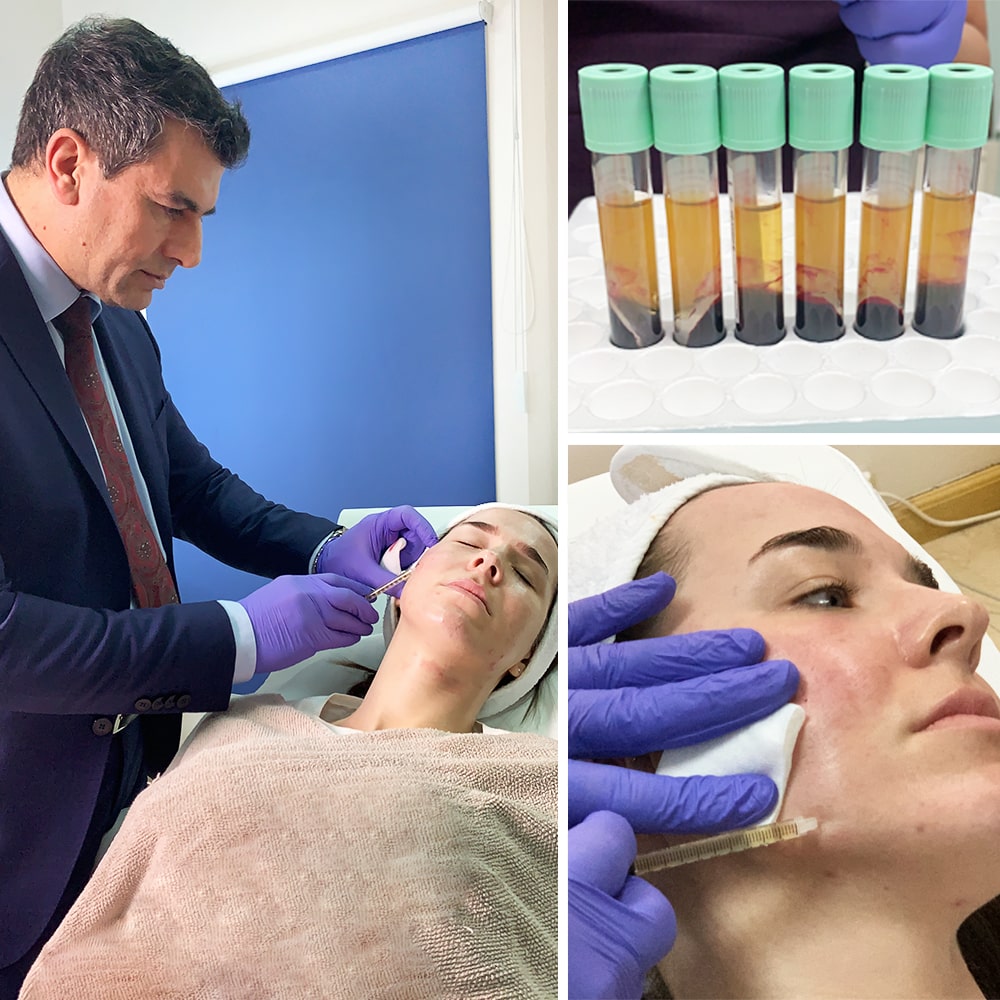 PRP Therapy PRP Therapy