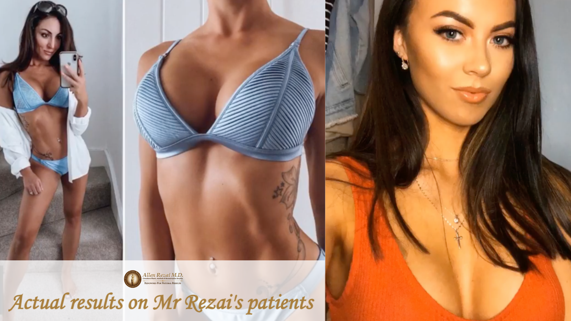 Allen Rezai Natural Look Breasts Allen Rezai Natural Look Breasts