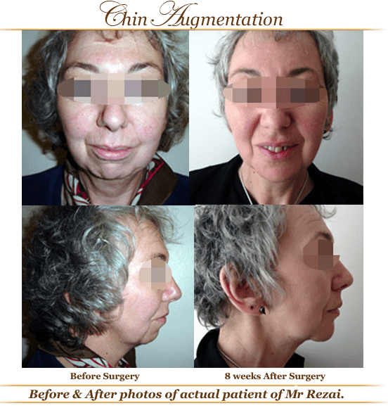 Before-and-after-chin1