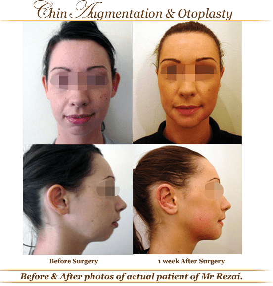 Before-and-after-chin2 Before-and-after-chin2