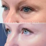 Eyelid BA 1