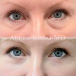 Eyelid BA 2