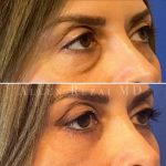 Eyelid BA 3